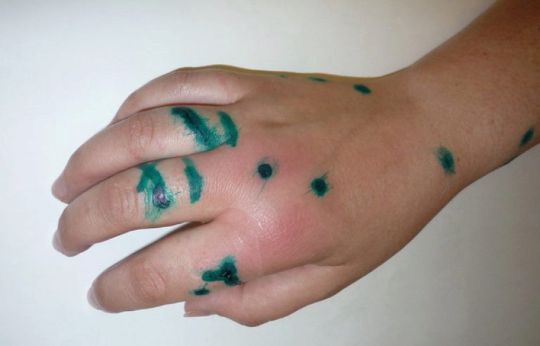 Онемение пальцев правой руки: физиологические причины